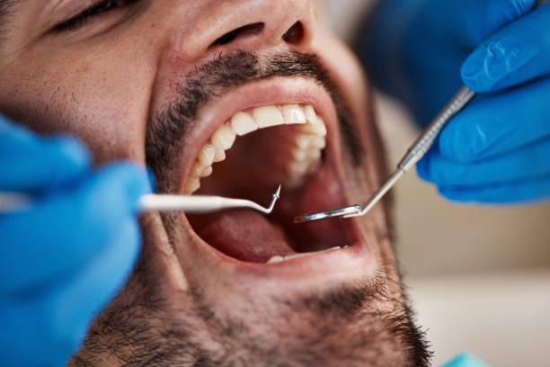 Best Emergency Dentist for Knocked-Out Tooth in Lake Kiowa, TX