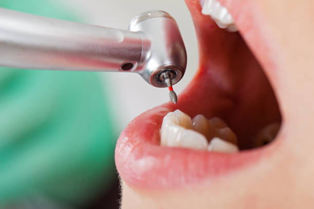Best Emergency Root Canal Treatment in Lake Kiowa, TX